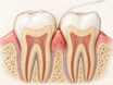 A cross-section of two teeth and gum tissue shows dental plaque along the gumline and a strand of floss gently entering the sulcus; inflamed gum tissue contains fragile capillaries, explaining why gums may bleed when flossing.