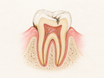 Cross-section of a tooth at the gumline showing a dark surface stain on the enamel and a deeper dark area extending into dentin, illustrating that black spots can have different causes beneath the surface.