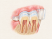 Cross-section of upper front teeth with a clear whitening tray in place, showing a thin line of gel only on the enamel and a protective barrier along the gumline to show safe at-home whitening.