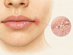 Close-up of lips and mouth corners showing a red, cracked corner with faint white patches, alongside a magnified view of round Candida yeast cells on the moist skin surface, representing lip fungus and angular cheilitis.