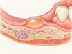A cross-section of the inner lip shows a fluid-filled blister raising the oral mucosa, with underlying capillaries and a nearby tooth edge, illustrating how irritation or injury can lead to mouth blisters.