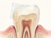 A front tooth cross-section with a whitening strip releasing peroxide into the enamel to lighten yellow surface stain, while a deeper gray-brown intrinsic stain in the dentin remains unchanged.