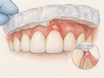 Close-up view of upper front teeth with a whitening tray being removed; a small area of gumline is red and swollen with a pale patch, showing a mild chemical burn from whitening gel, while surrounding gums remain healthy pink.